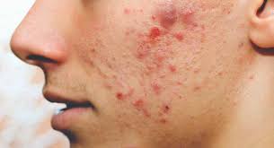 best pimples treatment clinic in bhubaneswar near ayush hospital